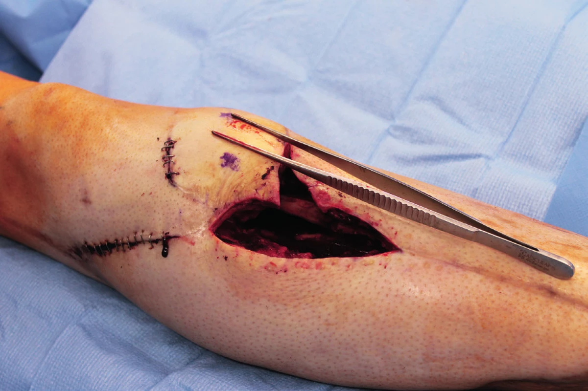 LCP proximal tibia plate was removed and a radical
debridement was performed after marking all fistula folds with
patent blue marker
