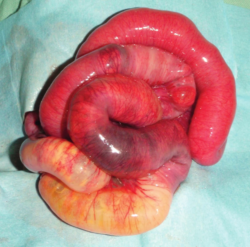 Peroperační nález střevní nekrózy u NEC.<br>
Fig. 2. Intestinal necrosis in surgically treated patient.