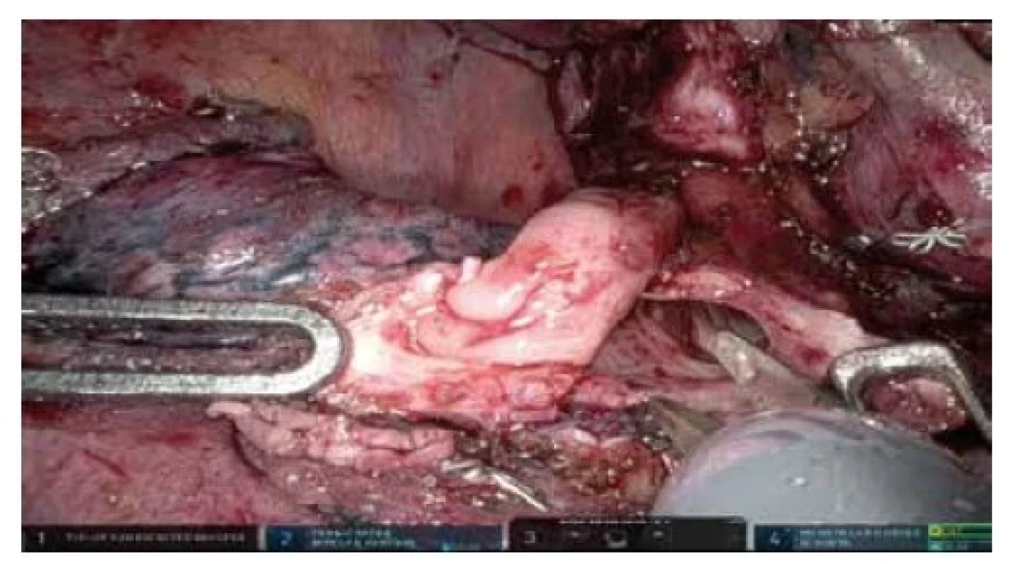 Robotická segmentektomie S6 vpravo pro typický
karcinoid, nůžky otevírají segmentární bronchus a dislokují
bělavou masu karcinoidu z intraluminálního šíření
do bronchus intermedius<br>
Fig. 3: Robotic segmentectomy S6 right for typical karcinoid
with intraluminal growth into bronchus intermedius