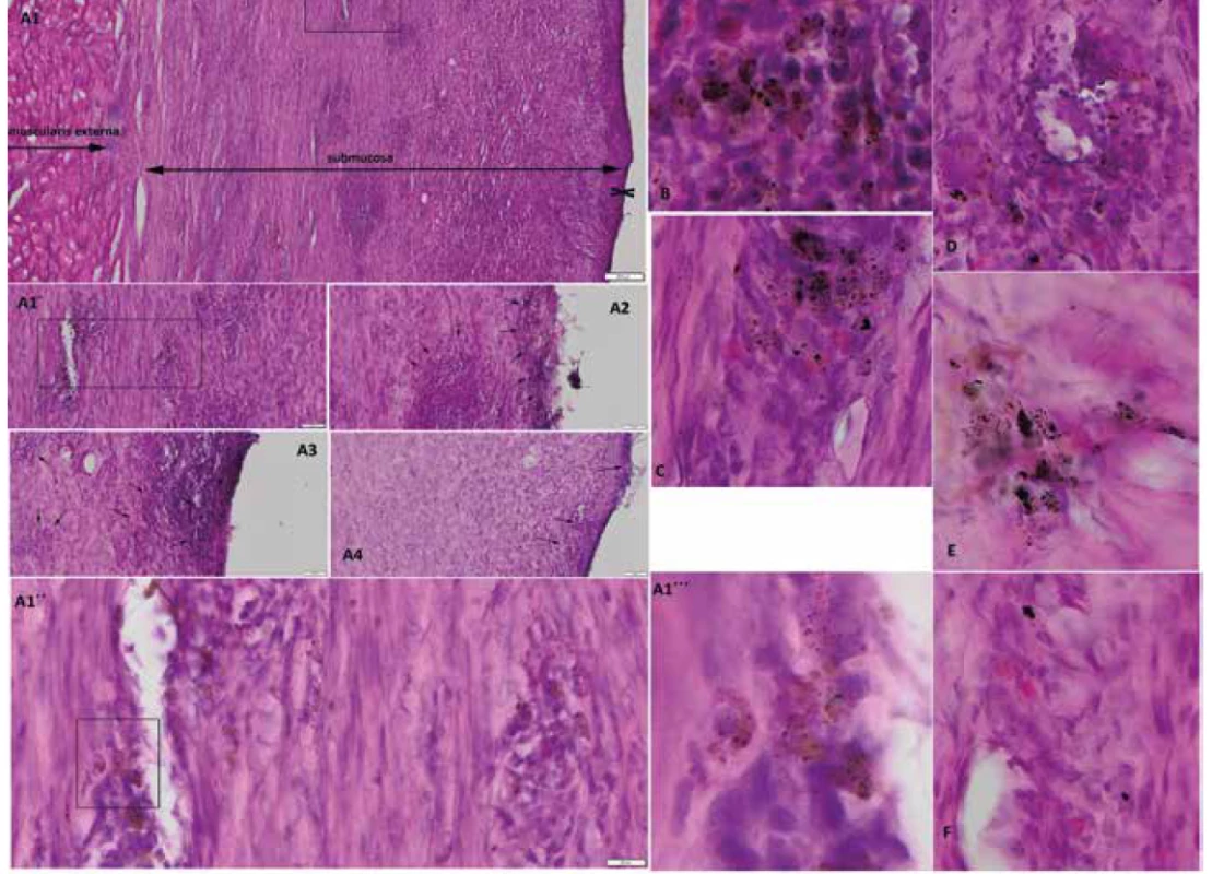 Detection of primary oral keratinocytes and mesenchymal stem cells in post-CED defects 17-36 days after transplantation
in hematoxylin-eosin stained sections by bright-field microscopy<br>
CED defect of animal L139 with muscularis externa, a large portion of submucosa containing tracked pOKs and MSCs and thin cicatricial
mucosa two opposite arrowhead bounded (A1, scale=200μm; A1´detail from A1, scale=50μm; A1´´detail from A1´, scale=20μm;
A1´´´detail from A1´´, 400x magnification). Tracked pOKs and MSCs (black-brown particles, arrows) in submucosa and cicatricial mucosa
of animal L139 (scale=50μm). Tracked cells in submucosa of animal L531 (B), T61 (C), T67 (D), T79 (E) and T83 (F) (200x magnification).