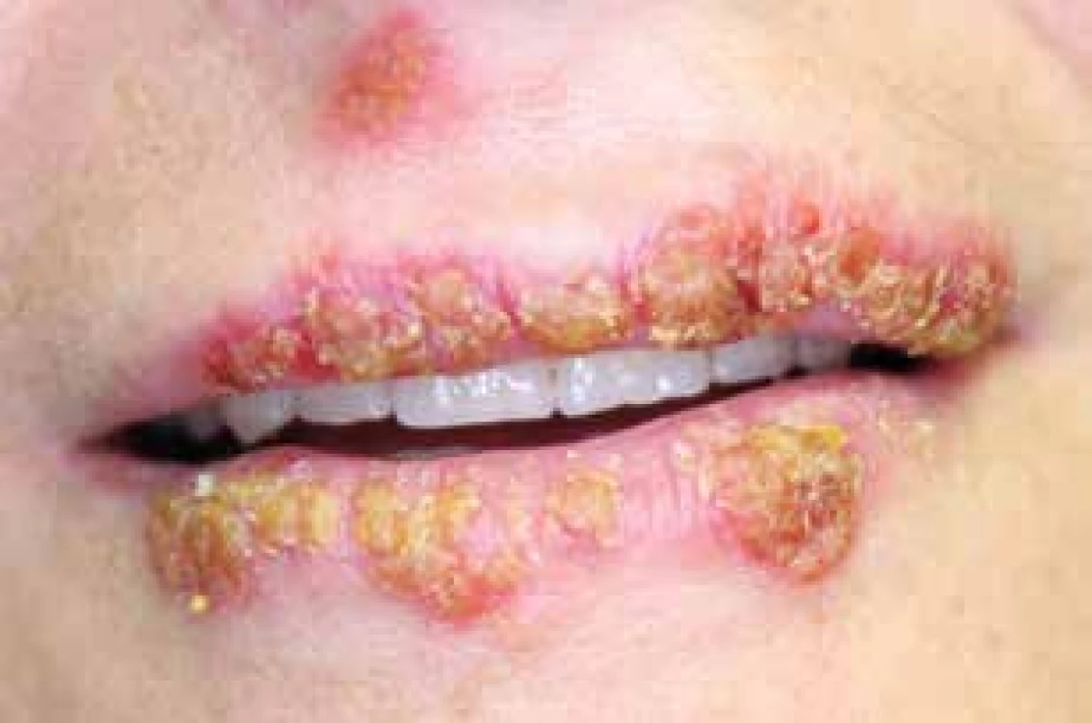 Herpes labialis