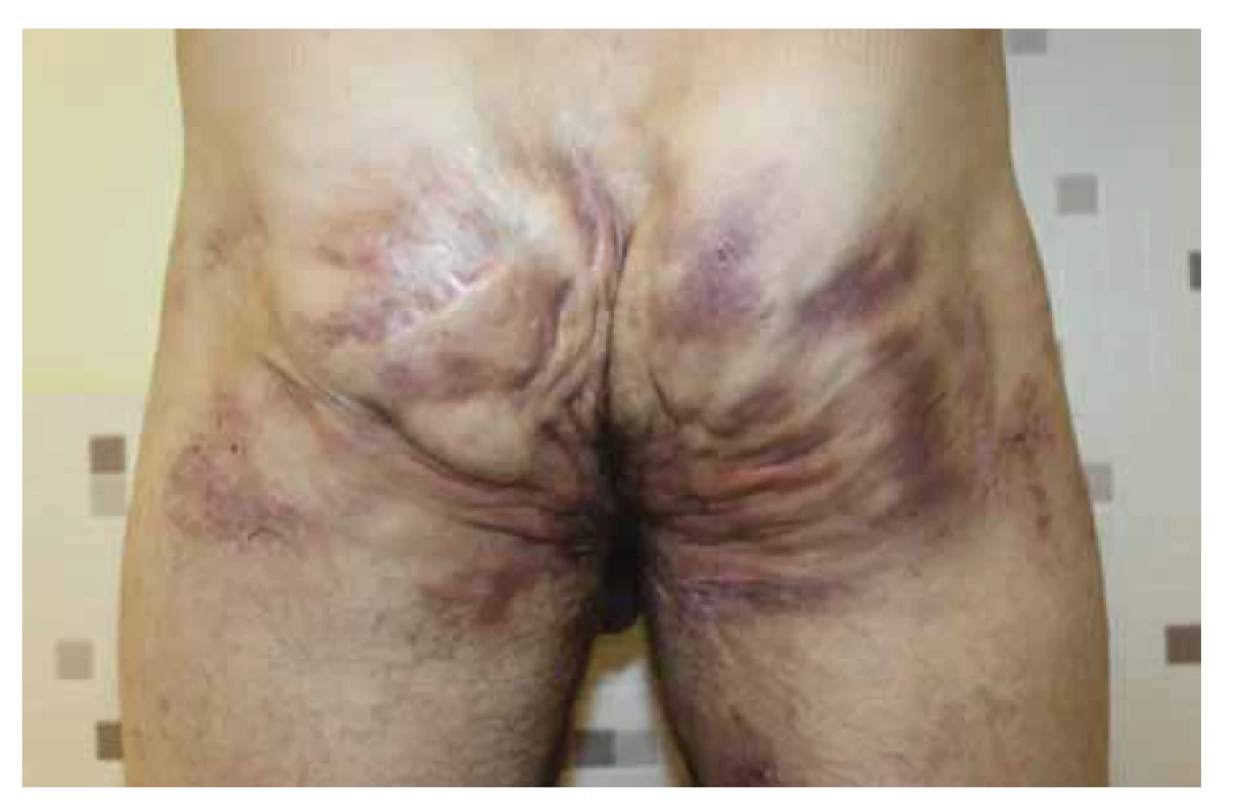 Pacient s hidradenitis suppurativa v gluteálnej oblasti Hurley III,
kolonoskopicky vylúčené IBD.<br>
Fig. 2. Patient with hidradenitis suppurativa in gluteal region (Hurley III), repeated
colonoscopy ruled out IBD.