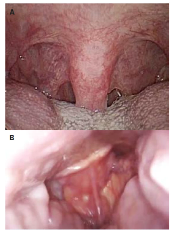 Nejčastější příčiny obstrukce HCD ve spánku:<br>
a) pokles zadních patrových oblouků a prodloužená uvula<br>
b) kolabující <i>epiglottis</i>