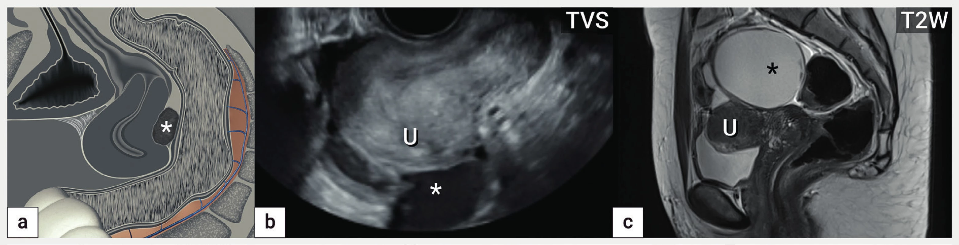 Děloha tvaru otazníku<br>
Schéma obliterace pánve s patrnou dělohou tvaru ‚otazníku' na podkladě adhezí zadní stěny děložní k endometroidní cystě (hvězdička),
zároveň přítomny srůsty obliterující vezikouterinní pliku (a), ultrazvukový obraz dělohy s pevnou adhezí zadní stěny k endometroidní cystě
(hvězdička) (b), magnetická rezonance obliterovaného Douglasova prostoru na podkladě fixace dělohy k velké cystě (hvězdička) (c).
U – uterus, TVS – transvaginální sonografie, T2W – T2 vážené obrazy v magnetické rezonanci