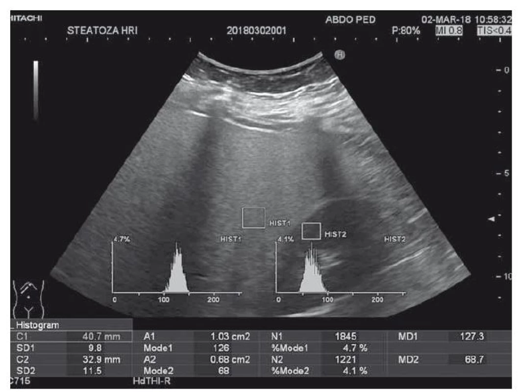 Hodnotenie steatózy pečene u obéznych pediatrických pacientov pomocou
ultrasonografie (HRI  1,85).<br>
Fig. 1. Evaluation of liver steatosis in obese paediatric patients using
ultrasonography (HRI 1,85)