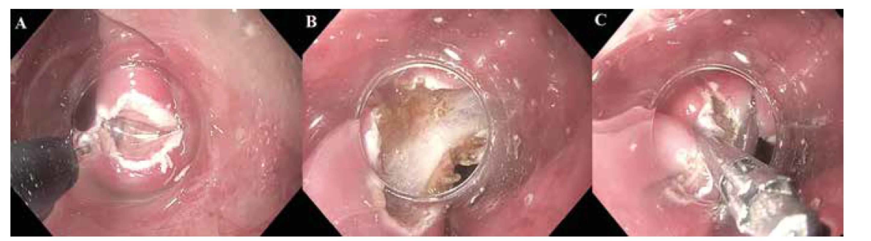 Zenkerův divertikl – septotomie<br>
Fig. 2: Zenker´s diverticulum – septotomy