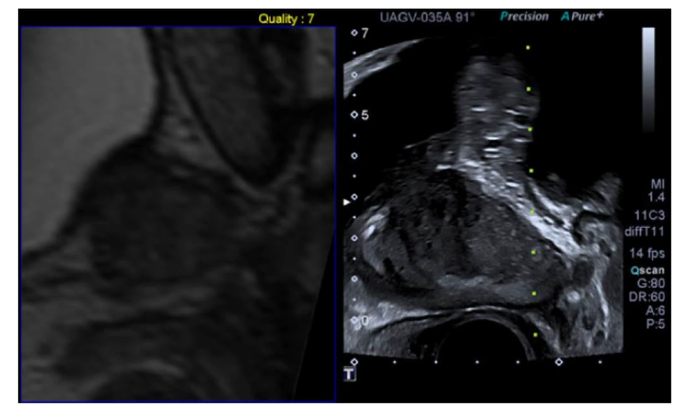 Softwarová mpMRI/US fúzní biopsie. Archiv autora<br>
Pic. 3. Software mpMRI guided fusion biopsy. Author’s archive