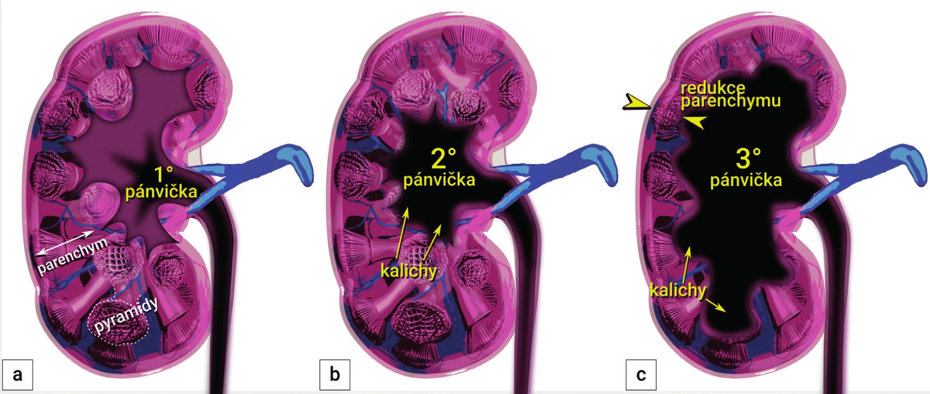 Stupně hydronefrózy<br>
První stupeň (dilatace pánvičky) (a), druhý stupeň (dilatace pánvičky a kalichů) (b), třetí stupeň (dilatace pánvičky a kalichů a redukce korového
parenchymu) (c)