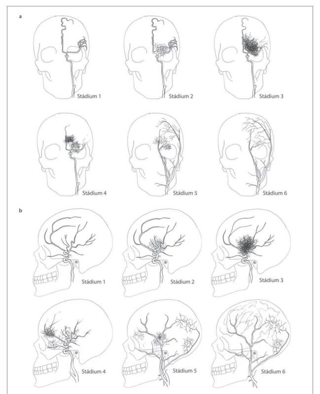 Suzukiho klasifikace – (a) předozadní projekce; (b) bočná projekce.<br>
Fig. 1. Suzuki classification – (a) anterior-posterior projection; (b) lateral projection.