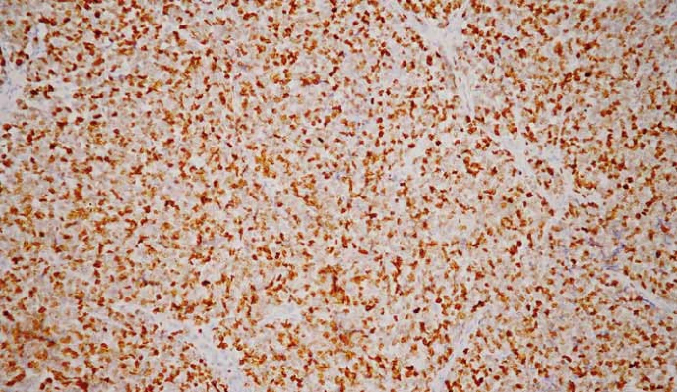Neuroendokrinný karcinóm G3. Imunohistochemické vyšetrenie s protilátkou proti Ki-67. Pozitivita Ki-67 > 20 %. 3,3-diaminobenzidín, 200×.