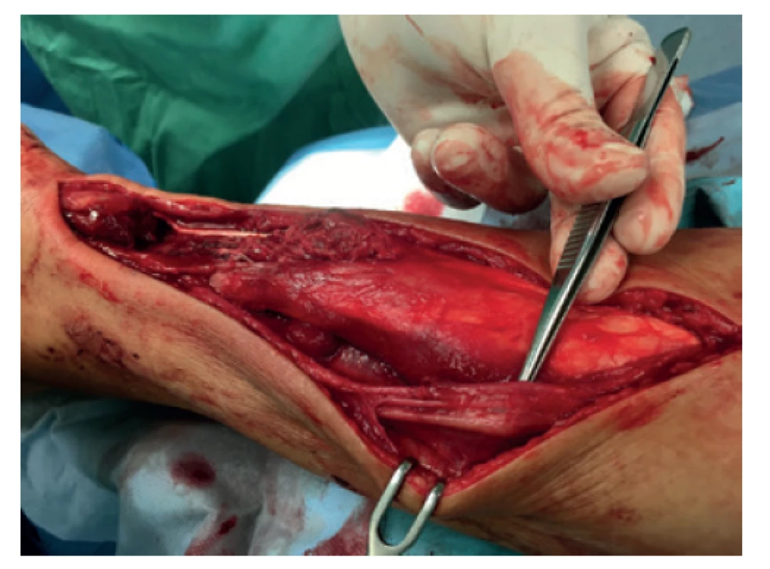 Ochrana nervově-cévních struktur (n. suralis, v. saphenaparva),
patrný rozsah defektu ve šlaše cca 8 cm<br>
Fig. 1: Protection of the neurovascular bundle (sural
nerve, small saphenous vein); tendon defect sized approximately
8 cm is shown