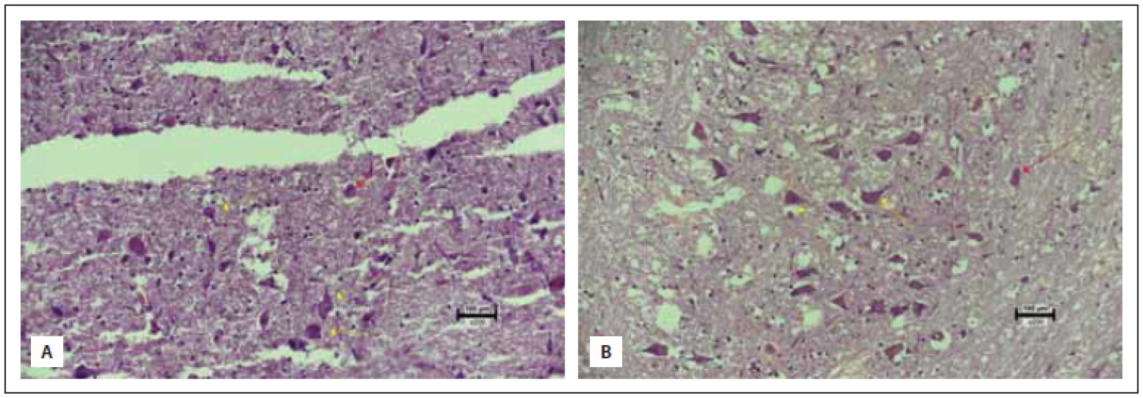 (A) Significant neuronal loss and neuronal degeneration in the trauma group (score 0). (B) Neurons are preserved in the sumatriptan
group, but continued degeneration (score 3) (hematoxylin eosin 200×). <br> 
Obr. 2 (A) Významná ztráta neuronů a degenerace neuronů ve skupině s traumatem (skóre 0). (B) Ve skupině na sumatriptanu jsou sice
neurony zachovány, ale pokračuje degenerace (skóre 3) (hematoxylin-eozin 200×).