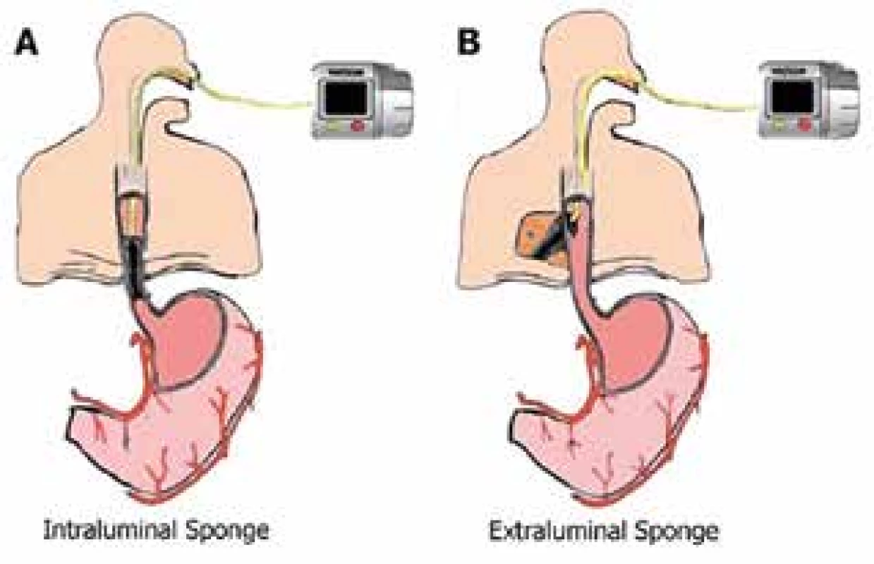 Endo-sponge: A- intraluminálne umiestnenie, Bintrakavitárne umiestnenie<br>
Fig. 2: Endo-sponge: A- intraluminal placement, B- intracavitary placement