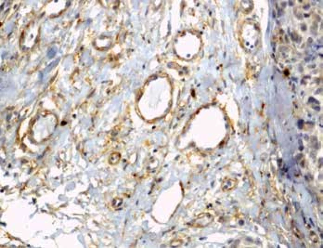 Imunohistochemický průkaz protilátky anti-CD90 v novotvořených
kapilárách na periferii tumoru (zvětšení 200x).