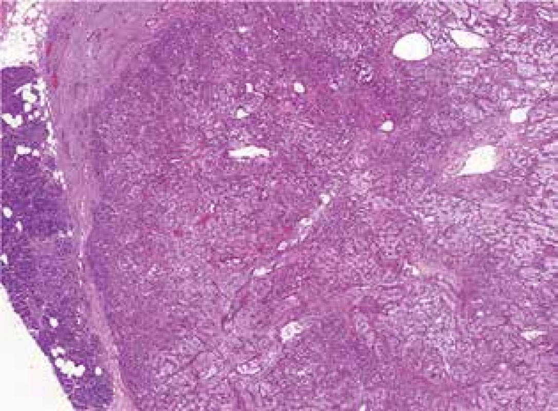 Metastáza světlobuněčného karcinomu ledviny
do pankreatu v CT obraze<br>
Fig. 3: Glandular tissue of the pancreas infiltrated by
metastatic water-clear cell renal carcinoma