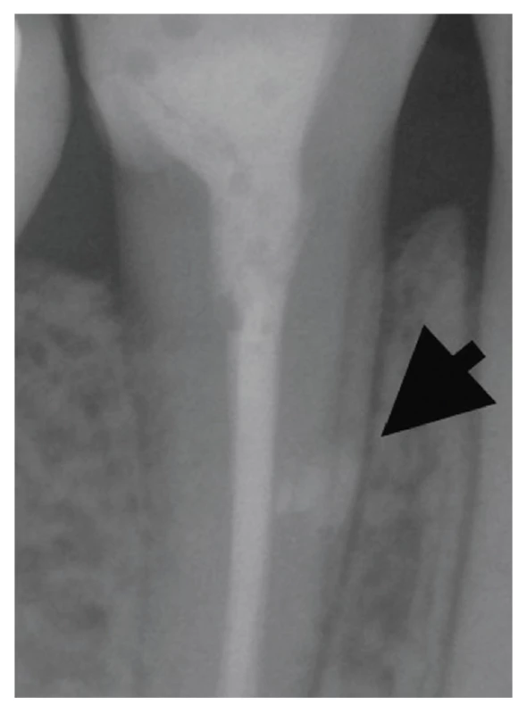 RTG snímek zobrazující schopnost sealeru vyplnit i mechanicky neopracovaná místa kořenového kanálku, jako je laterální akcesorní kanálek <br>
Fig. 5 X-ray image showing the ability of a bioceramic-based sealer to fill the mechanically uninstrumented space in the root canal, as a lateral root canal