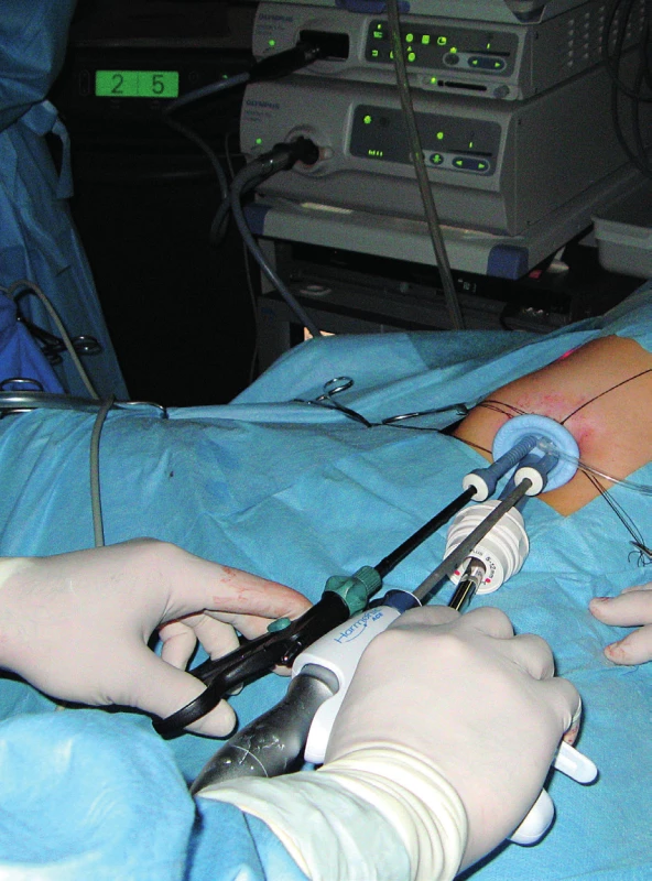 Laparoskopická operácia cez jeden vstup.<br>
Fig. 4. SILS (Single Incision Laparoscopic Surgery).