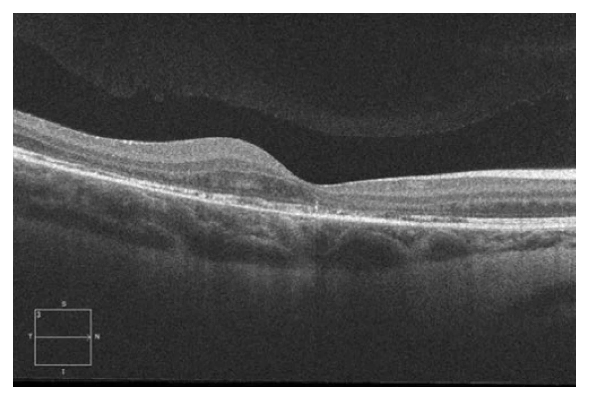Spektrální HD OCT Lineární horizontální makulární sken
po 3. intravitrálních aplikacích ranibizumabu (Lucentis) v dlouhodobém
sledování (˃ 12 měsíců) se stabilním makulárním nálezem,
bez další progrese