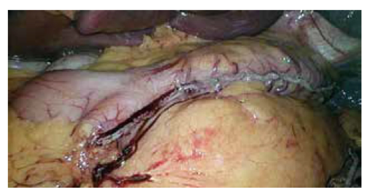 Pohled na resekční linii remnantu žaludku po LSG<br>
Fig. 2: View of the resection line of the stomach residuum
after laparoscopic sleeve gastrectomy