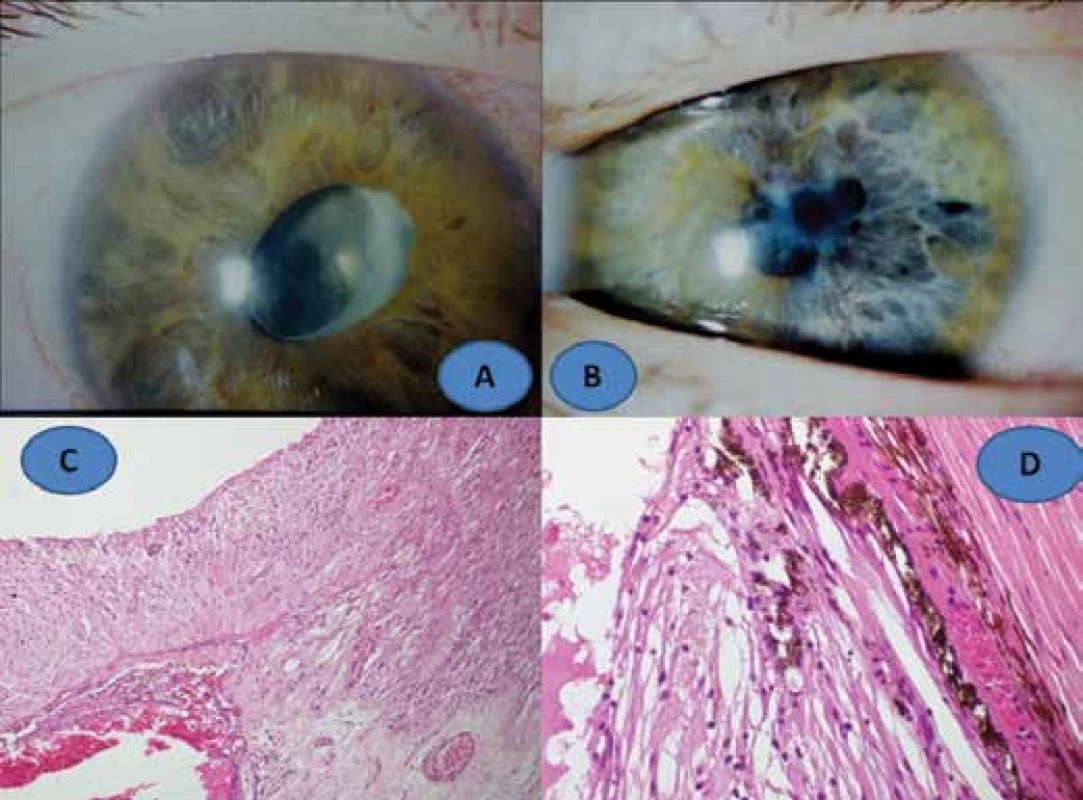 Clinical finding of phacoantigenic uveitis in 14 year old girl: right eye (A), left eye (B),
histological finding: fibrotised ciliary body with gliosis of detached retina, enlargement 100x,
HE (C), gliosis of retina and fibrotisation of choroid, enlargement 400x, HE (D)