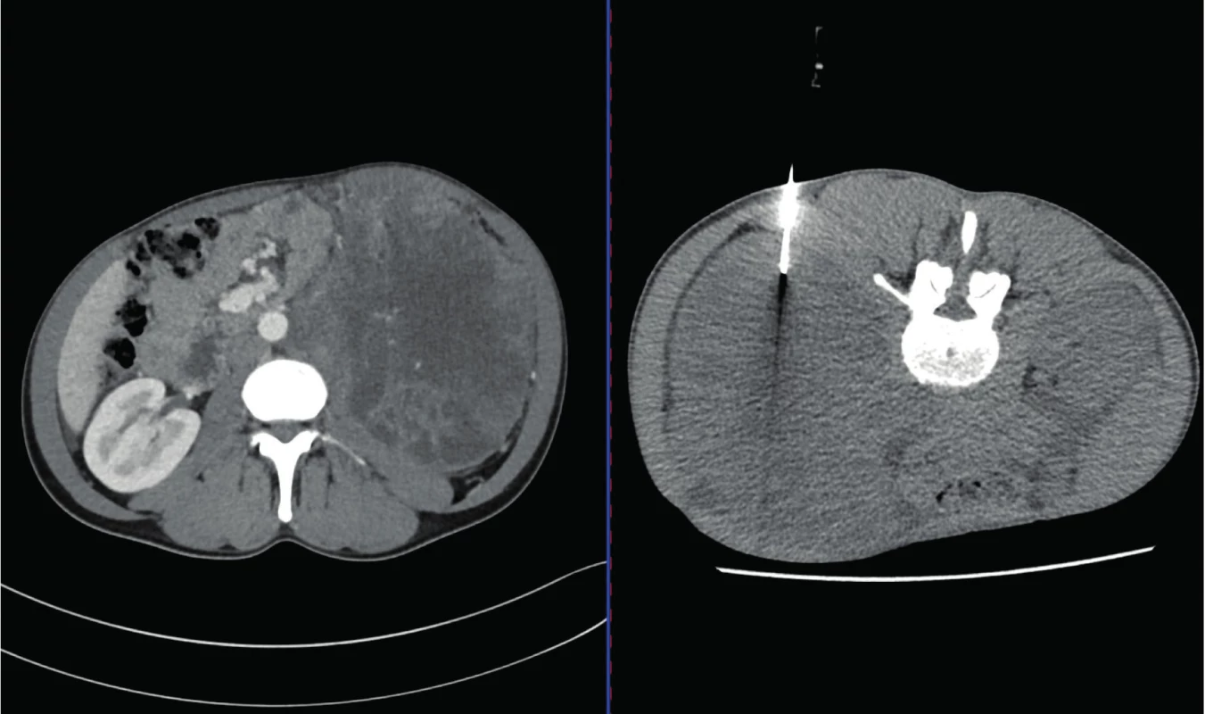 CT, transverzální řez. Muž, 35 let. Vlevo snímek CT před biopsií s popisem objemného tumoru levé ledviny a retroperitonea s prorůstáním do dolní duté žíly, vpravo snímek v průběhu biopsie. Histologicky nádor ze
žloutkového váčku<br>
Fig. 2. CT scan, transverse plane. A thirty-five year old male. In the left picture – CT scan prior to the biopsy with
the description of the tumor of the left kidney and retroperitoneum with the vena cava inferior invasion. In the
right picture – CT scan during the biopsy. Histologically Yolk-sac tumor