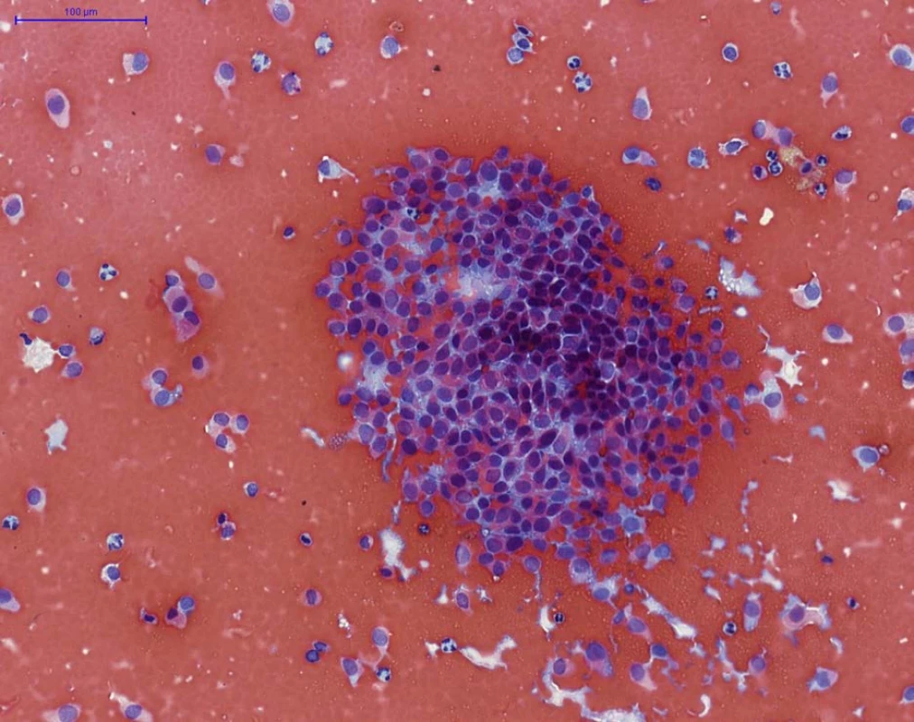 NHGUC (barvení PAP) – četné hluboké urotelie, bez výraznějších cytologických atypií, místy vytvářející
až naznačeně trojrozměrné klastry (v centru), na pozadí četné erytrocyty. Tento nález je vysoce suspekní z low-
-grade uroteliální neoplazie, avšak nesplňuje morfologická kritéria Pařížské klasifikace pro označení „LGUN“.(pozn.:
z následné transuretrální resekce tumoru potvrzena přítomnost low-grade neinvazivního uroteliálního karcinomu
dle WHO 2016, grade 1 dle WHO 1973)<br>
Fig. 2. NHGUC (PAP staining) – numerous intermediate and deep urothelial cells are present, with no significant
cytological atypia, arranged focally as threedimensional fragments (in the centre), with erythrocytes in the
background. This finding is suspicious for low-grade urothelial neoplasia, but it does not fulfill the morphological
definition for category LGUN. (Note: subsequent transuretral resection of the tumor showed low-grade non-
-invasive papillary urothelial carcinoma according to WHO 2016 classification, grade 1 according to WHO 1973)