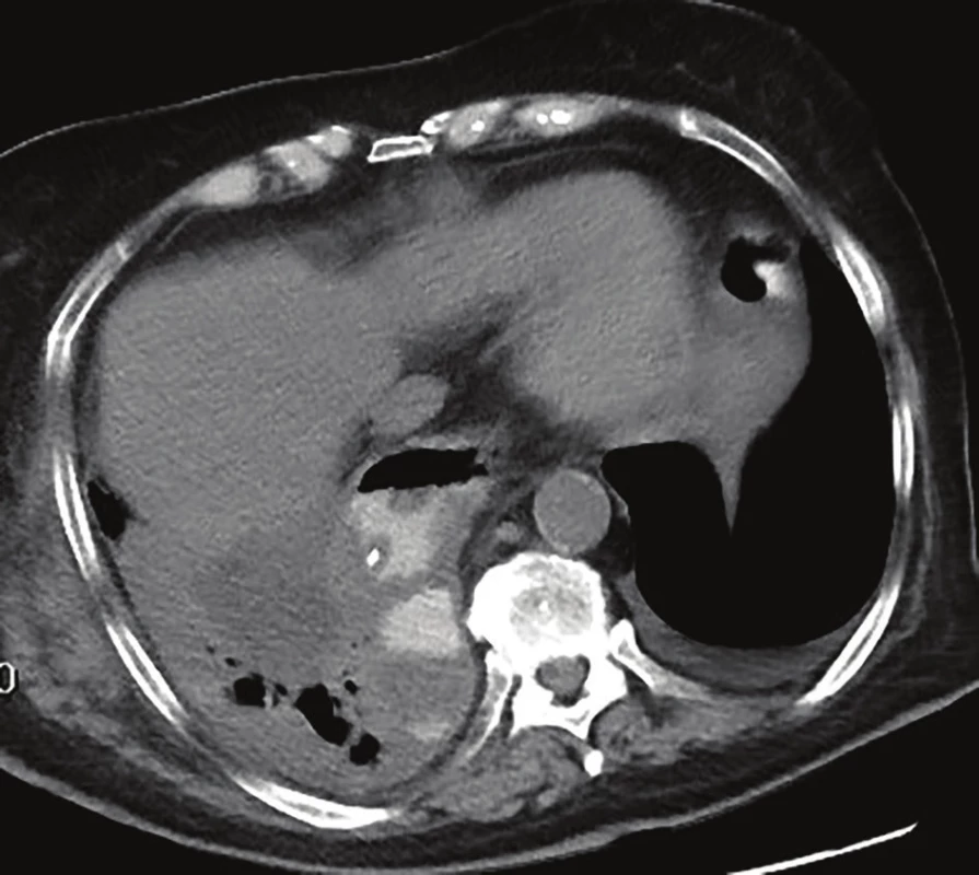 CT hrudníku – EVAC in situ v dutině paravertebrálně
vpravo<br>
Fig. 1: Chest CT – EVAC in situ in the right paravertebral cavity