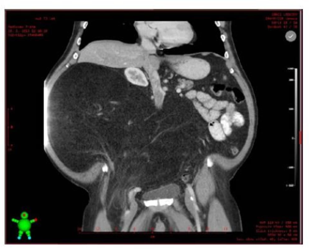 CT před operačním výkonem<br>
Fig. 1. CT before surgery