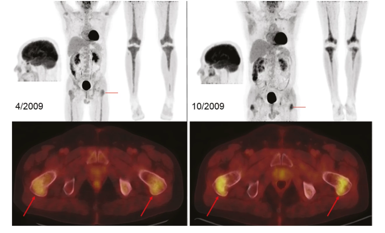 Monitorace léčby nemoci pomocí FDG-PET/CT vyšetření: Vlevo sken při zahájení terapie, MIP projekce hlavy, trupu i dolních končetin (v černobílé
barevné škále). V místech označených červeně jsou doplněny axiální fúzované řezy (v barevné škále Hot Body), s detaily FDG-avidního postižení proximálních
stehenních kostí (šipky). Vpravo pak identické skeny, které prokazují nárůsty akumulací FDG ve stehenních kostech, tibiích i maxille. Akumulace FDG
v mozku, ledvinách, močovém měchýři je fyziologická. Akumulace v myokardu, vzestupném tračníku je variantou fyziologického zobrazení