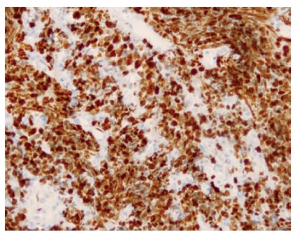 Přibližně 95 % buněk pozitivních v imunohistochemickém průkazu
proliferačního antigenu Ki-67. 200x.