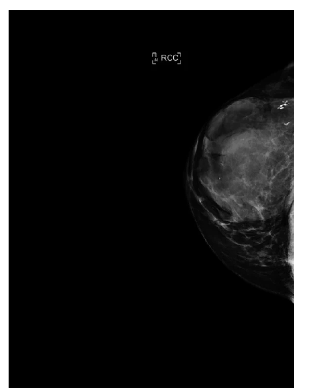 Mamograf, kraniokaudální projekce, primární tumor.<br>
Fig. 2: Mammogram, craniocaudal projection, primary
tumor.
