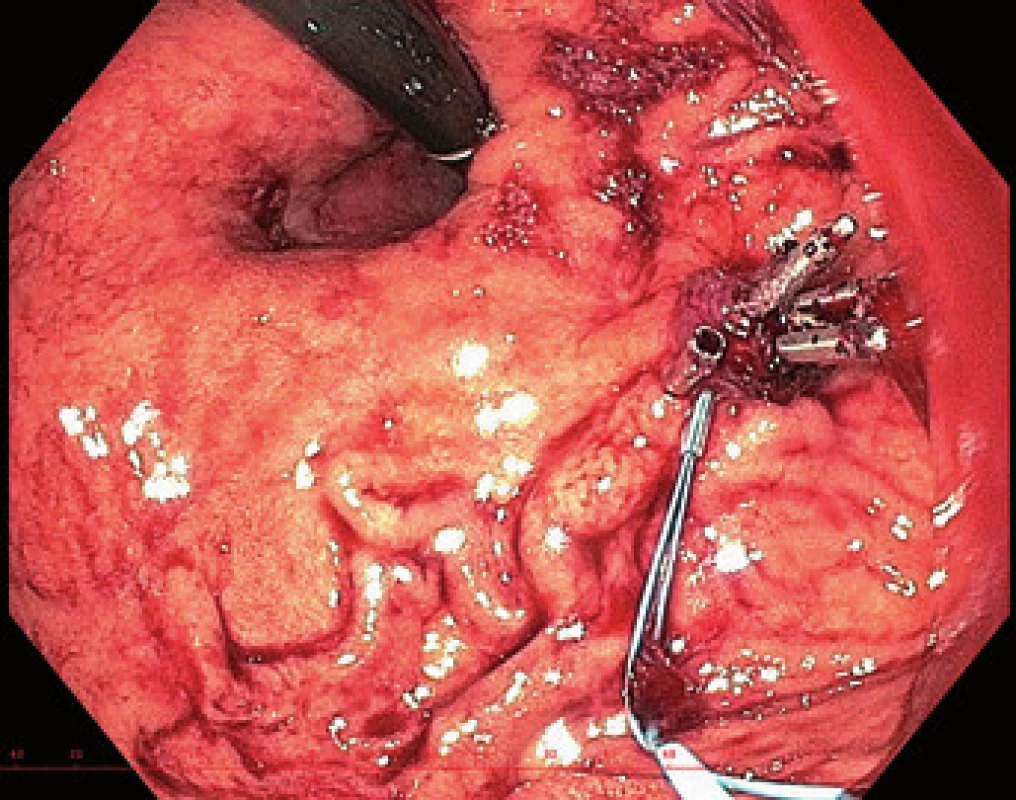 Esofagogastroduodenoskopie s aplikací endoskopické
ligatury (endoloop) a hemostatickými klipy. Zdroj:
doc. MUDr. Jan Martínek, Ph.D. AGAF, Klinika hepatogastroenterologie,
IKEM.
Fig. 1. Esophagogastroduodenoscopy with application
of endoscopic ligature and haemostatics clips. Source:
Assoc. Prof. Jan Martinek, Clinic of hepatogastroenterology,
IKEM.
