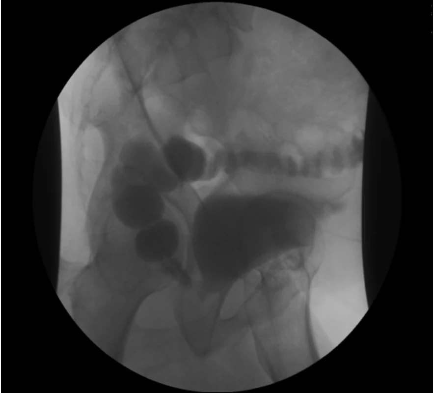 Průkaz rektoanastomotické píštěle uretrocystografií<br
Fig. 1. Diagnosis of the rectoanastomotic fistula on
urethrocystography