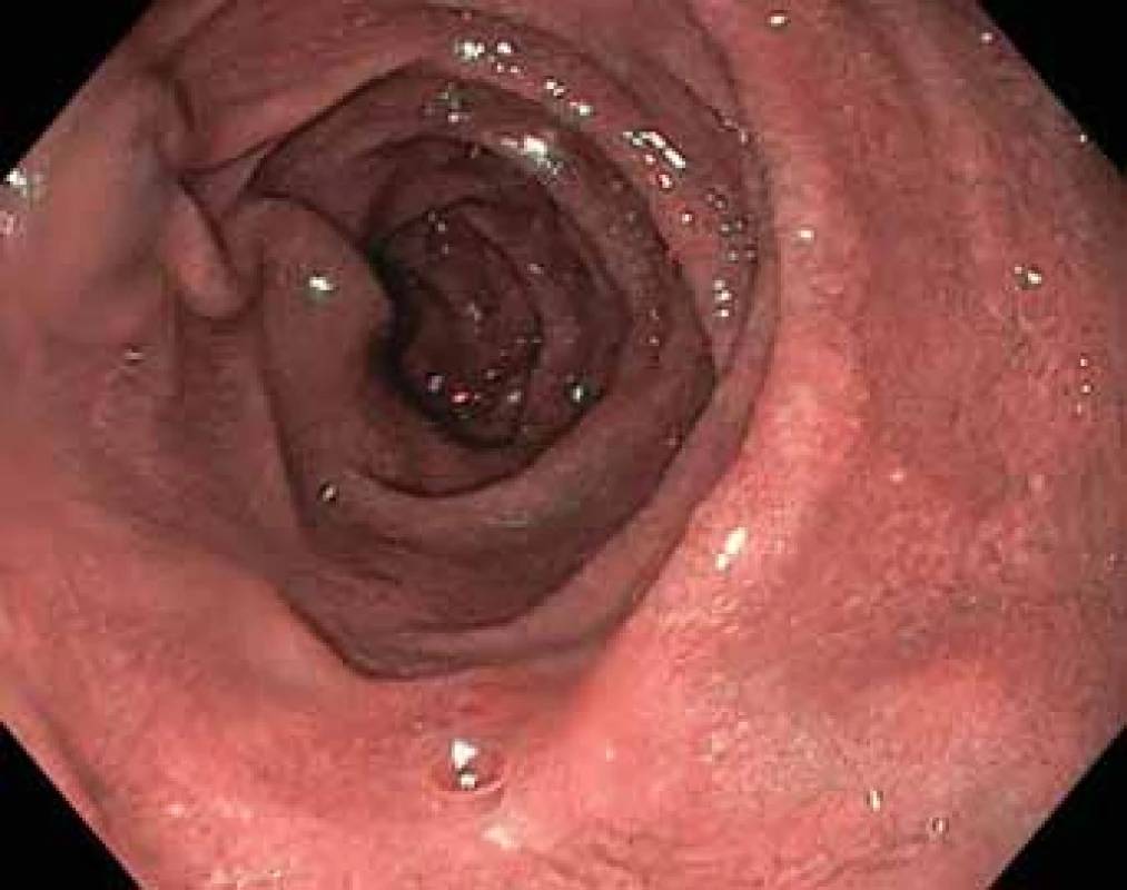 Postbulbární duodenum – remise NBI (narrow band imaging).<br>
Postbulbar duodenum – remission of NBI (Narrow Band Imaging).