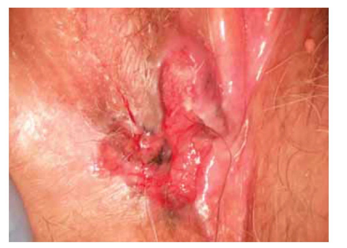 Pigmentovaná léze vulvy.<br>
Fig. 6. Vulvar pigmented lesion.