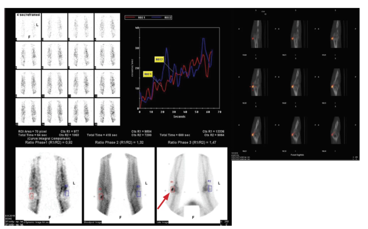 Přínos SPECT/CT – upřesnění patologické
léze k anatomické struktuře (3F loktů – známky
epikondylitis lateralis (radialis) vpravo).