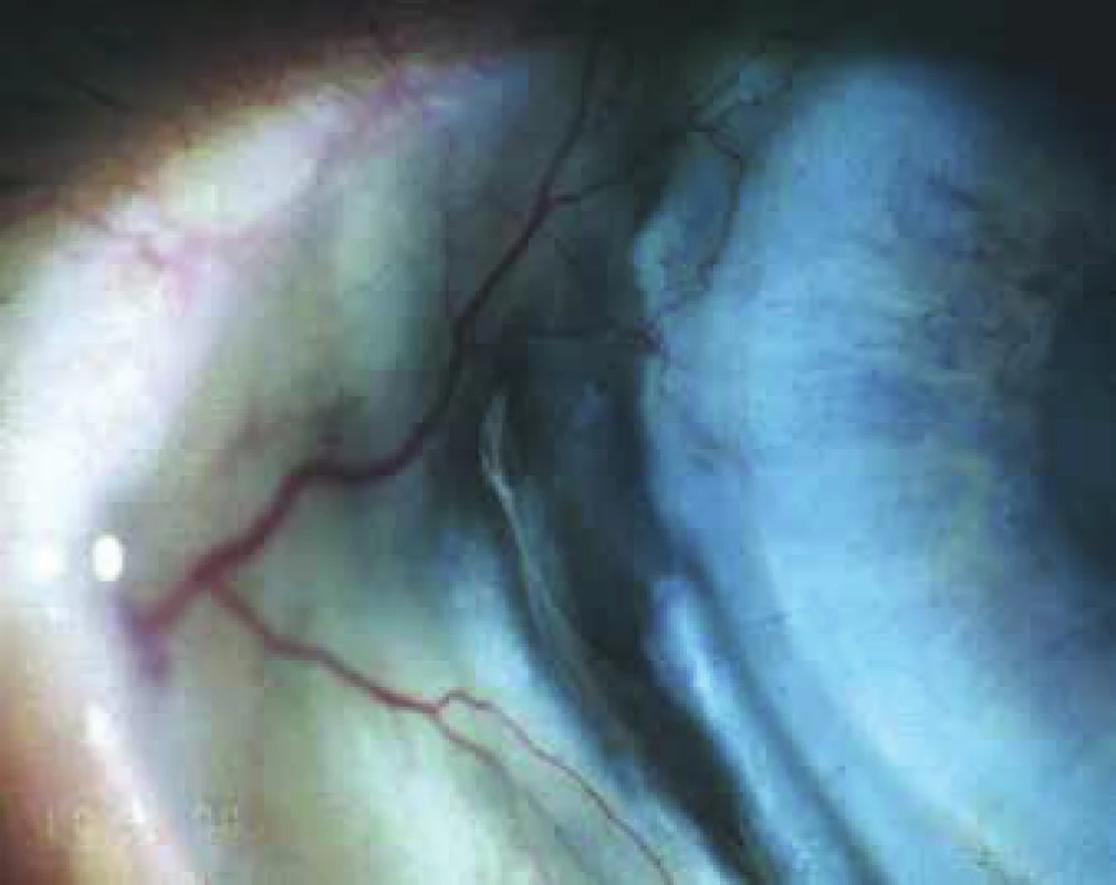 Semi-perforation of scleritis in untreated GPA