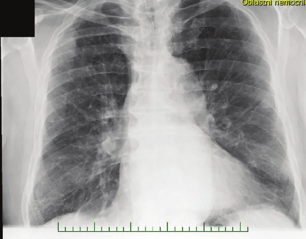 Suspektní metastázy na RTG snímku před provedením
PET/CT hrudníku<br>
Fig. 3: Native X-ray image of the lungs with suspected metastasis
before PET/CT of the trunk