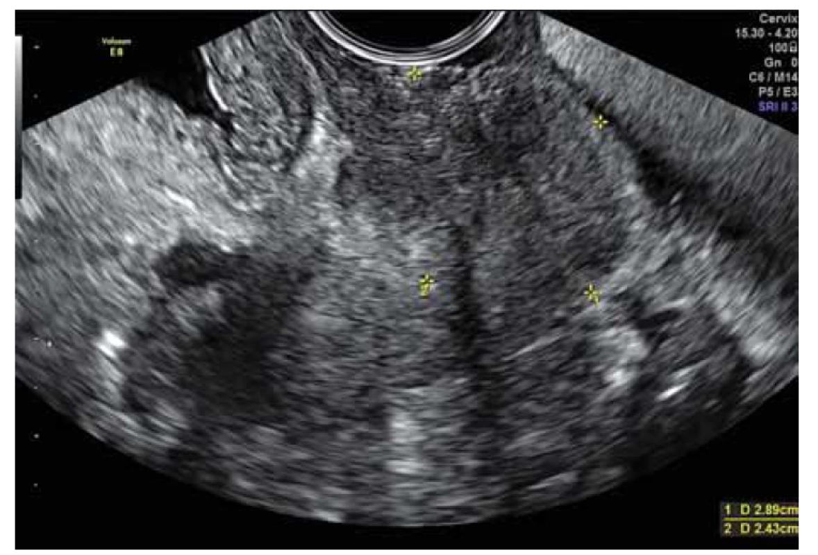 Ultrazvukový nález – 1. měsíc užívaní antituberkulotik, žlutě označen
cervix.<br>
Fig. 3. Ultrasound finding – 1st month of antituberculosis treatment,
yellow marks – cervix.
