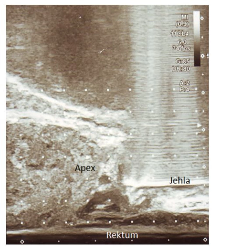 Aplikace lokálního anestetika k apexu prostaty
pod TRUS kontrolou (archiv autora)<br>
Fig. 2. The application of local anaesthetic around
the apex of the prostate under TRUS guidance (author’s
archive)