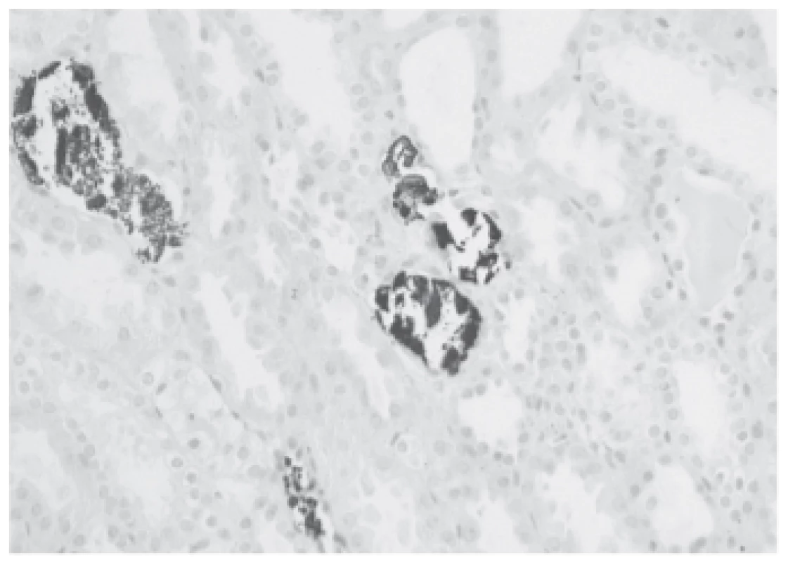Proof of calcium-phosphate salts in the microcalculi in
the tubular lumina (black, von Kossa staining).
