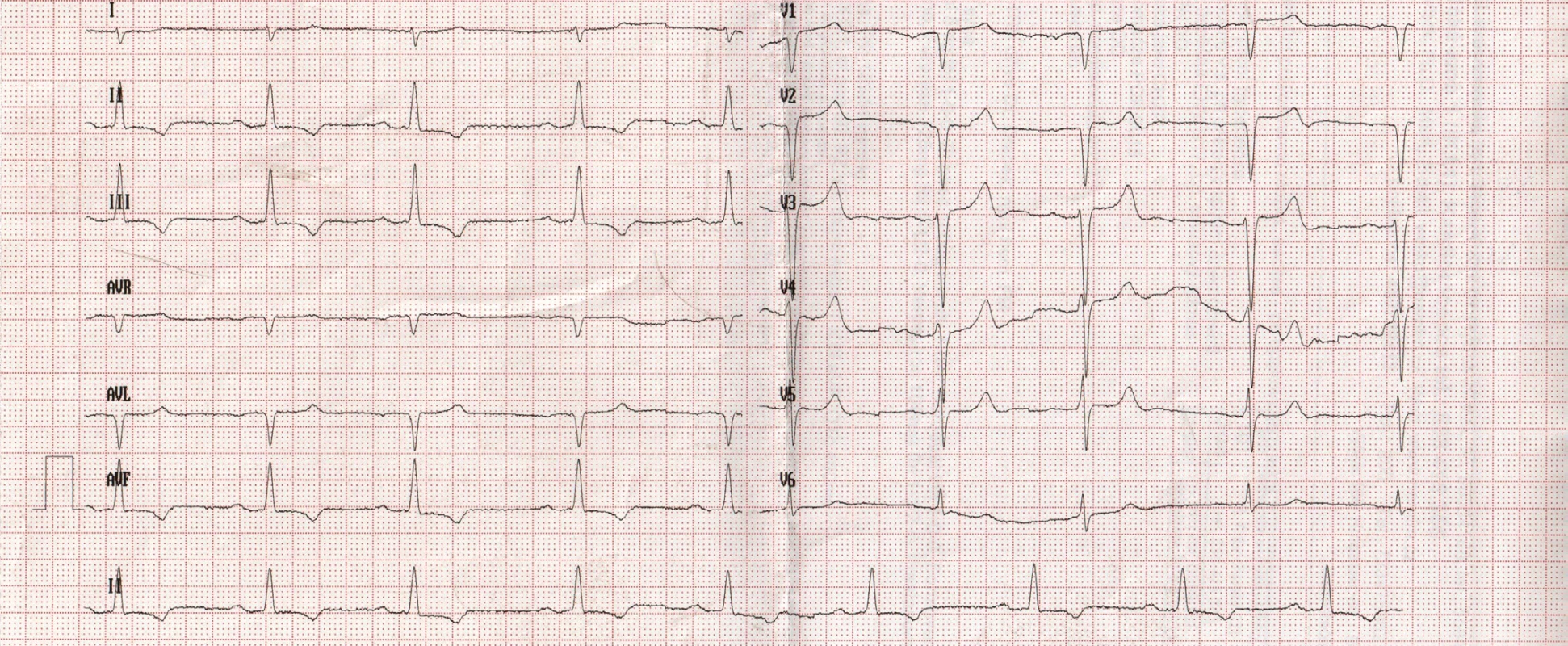 EKG