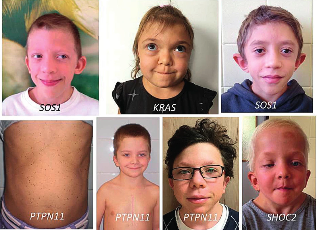 Příznačný faciální fenotyp spojený s jednotlivými kauzálními geny.<br>
Fig. 8. Typical facial phenotypes in children with individual causative genes.