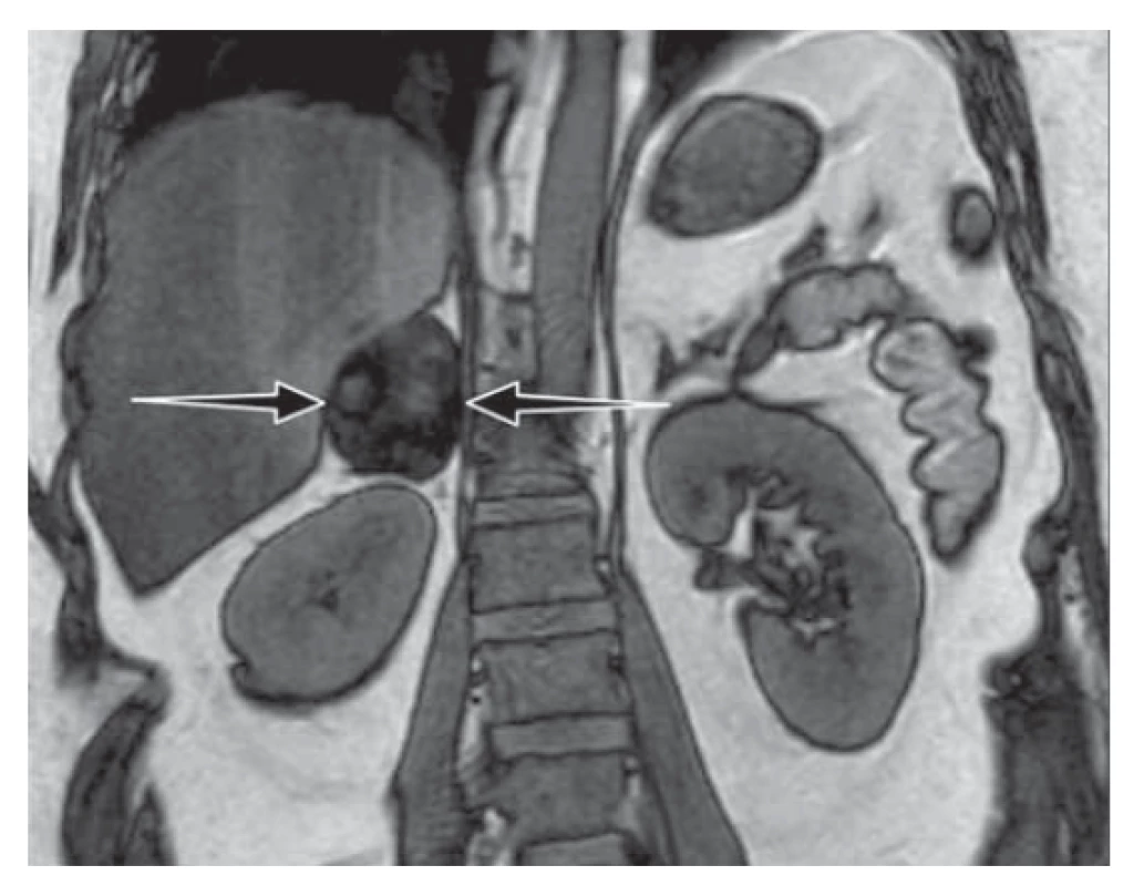 Nativní magnetická rezonance nadledvin: tumor
pravé nadledviny velikosti 55 x 40 x 50 mm s výrazným
lehce nehomogenním poklesem signálu out-of-phase sekvenci
odpovídající charakteru adenomu.<br>
Fig. 1. Magnetic resonance imaging without contrast showed
a mass on the right side of the adrenal gland (size
55 x 40 x 50 mm) with a lower signal indicating the characteristics
of the adenoma.