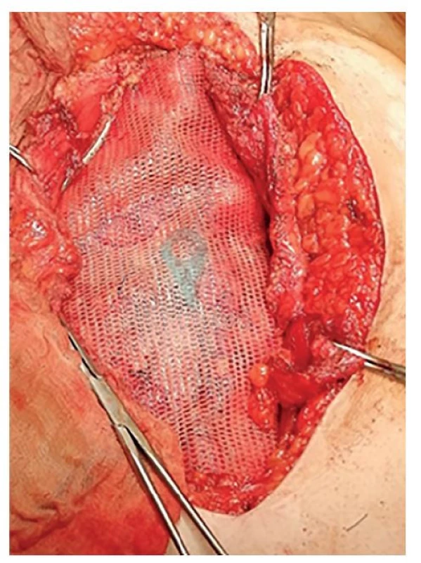 Vložený mesh do retromuskulárního prostoru<br>
Fig. 6: Mesh inserted into the retromuscular space