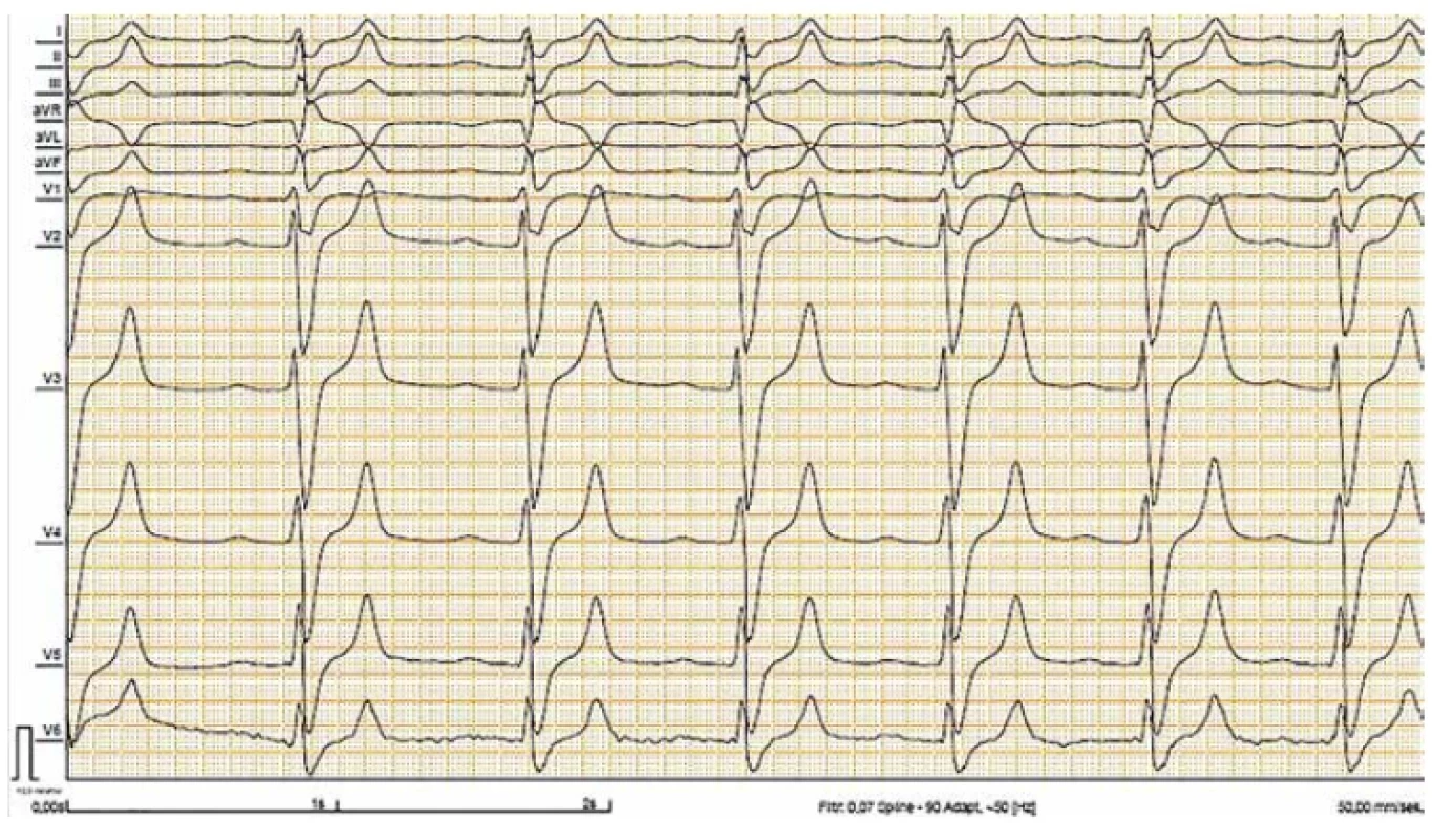 ECG changes in severe hyperkalemia