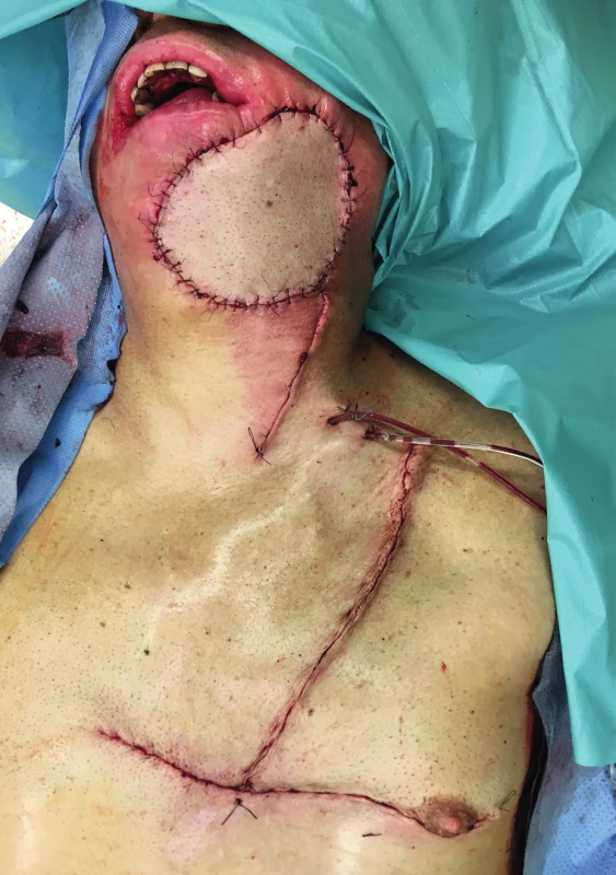 The immediate postoperative result