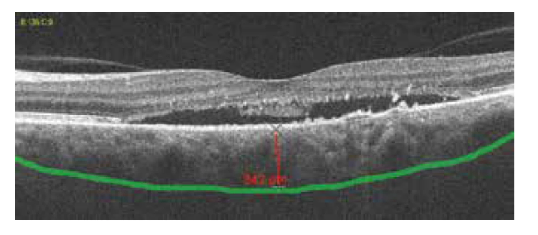Pachychoroid, tloušťka choroidey 342 um