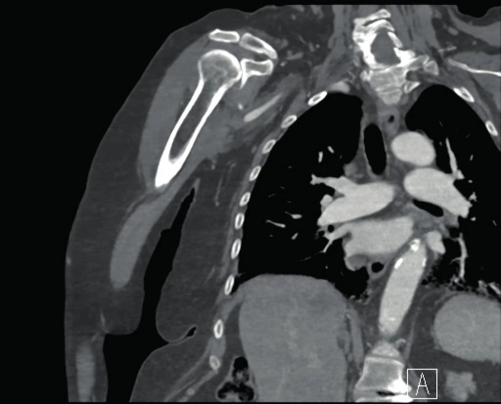 Without glenoid fracture on CT imaging