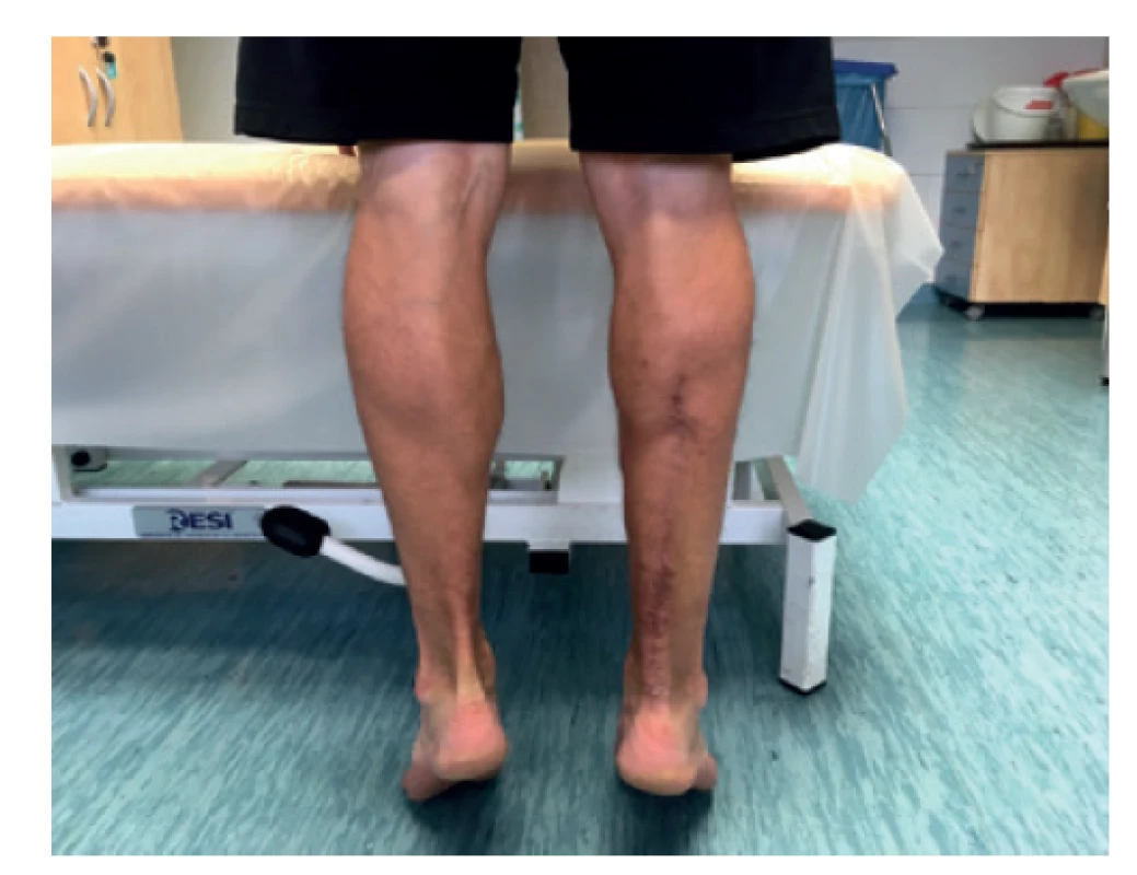 Plné zatížení po 12 měsících<br>
Fig. 5: Full weight-bearing 12 months from the surgery